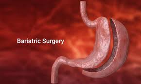 Bariatric Surgery